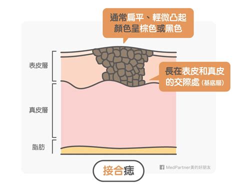 男生點痣|點痣筆一擦，黑痣就掉了？醫師冷笑科科兩聲：「點痣。